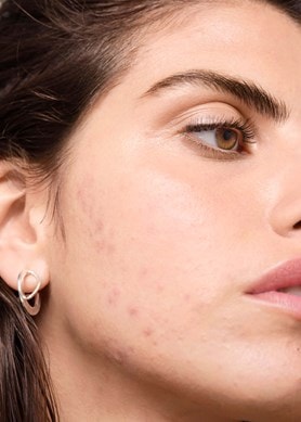 ha-uma-relacao-entre-laticinios-e-a-acne