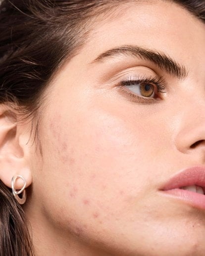ha-uma-relacao-entre-laticinios-e-a-acne