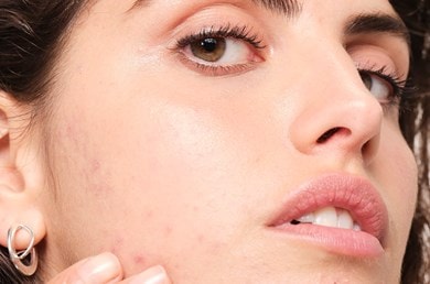 os-alimentos-podem-causar-acne